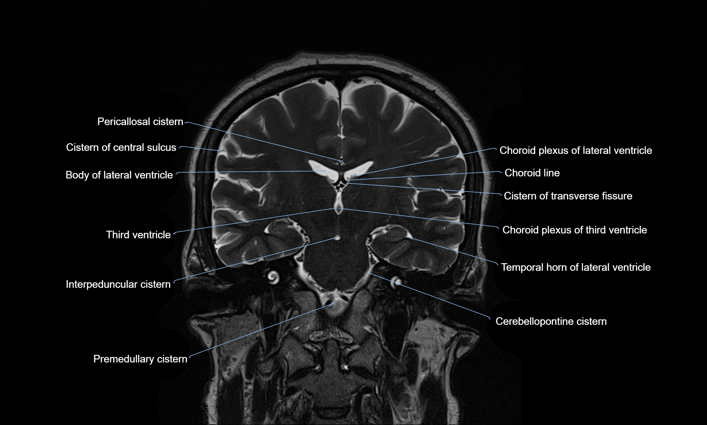 Brain cisterns  and ventricles coronal anatomy 3T MRI image-img-00001-00032.webp